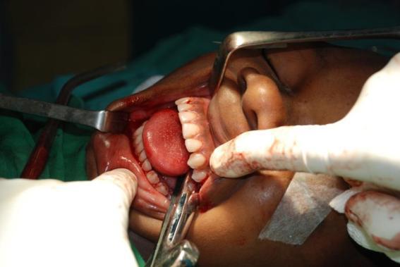 MAIKEL F. B.  DE 12 AÑOS anquilosis articulación temporo mandibular